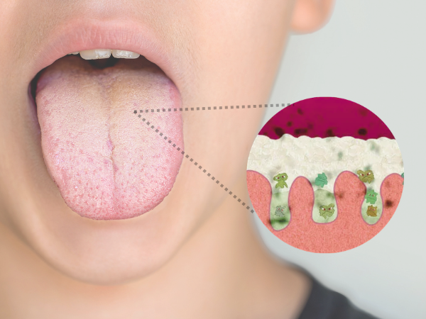 마곡역치과_7. 혀 클리너 꼭 써야 할까요? 설태 생기는 진짜 이유와 올바른 사용 기준 관련 이미지 1