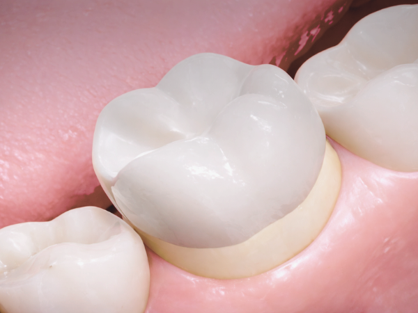 마곡치과_3. 재신경치료 과정, 신경치료 후 다시 아플 때 어떻게 진행될까요? 관련 이미지 5