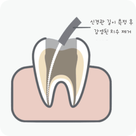 마곡동치과_ "치아 속 구조 복원 프로젝트" [2. 신경치료 단계별 진행 과정 ] 관련 이미지 3