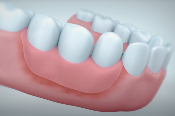 마곡역치과_&ldquo;입안이 불편하다면? 바로 잡아야 합니다!&rdquo; [ 6. 틀니 불편감과 해결법 ] 관련 이미지 2