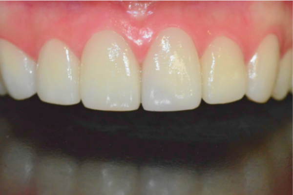 마곡동치과_4. 무삭제 라미네이트(디아네이트) 리얼 후기 3가지 케이스 관련 이미지 4
