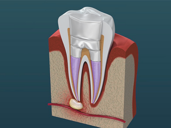 마곡역치과_ "안 아프다고 멈추면 더 위험해요!" [ 5. 신경치료 중단 시 생기는 문제들 ] 관련 이미지 3