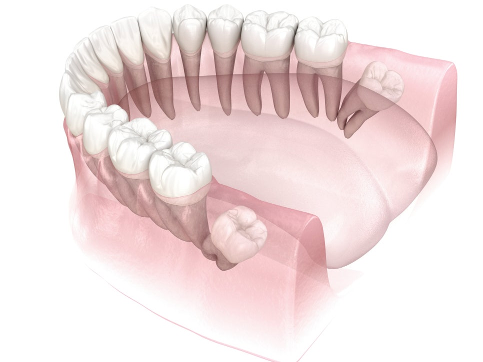 마곡역치과_3. 사랑니에도 종류가 있다? 매복, 수평, 정상 사랑니 비교 관련 이미지 3