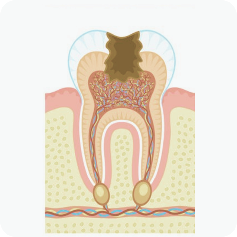 마곡동치과_"방치하면 임플란트까지?" [ 3. 충치 진행 단계별 치료 ] 관련 이미지 8