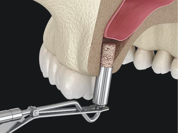 마곡동치과_4. 임플란트 뼈이식 비용과 결정 요인 관련 이미지 4
