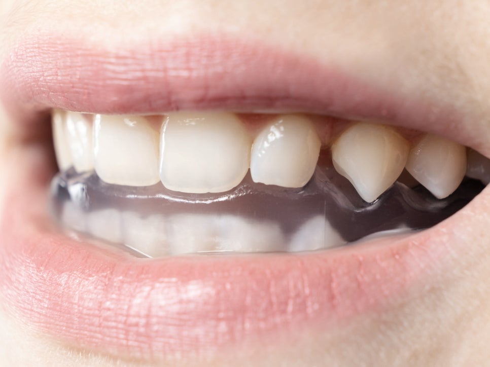 마곡치과_ 2. 이갈이 장치 사용 후기와 적응법 관련 이미지 1