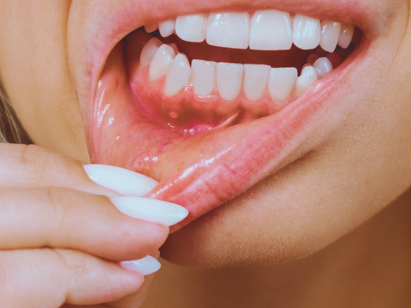 마곡동치과_"붓고 고름이 나와요" [1. 잇몸 고름 주머니 원인] 관련 이미지 1