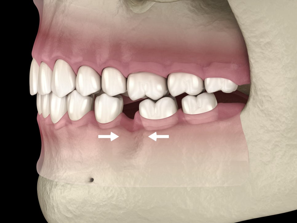 마곡역치과_6. 중장년기(50~60대) 구강 변화와 치아 상실 예방 관리법 관련 이미지 6