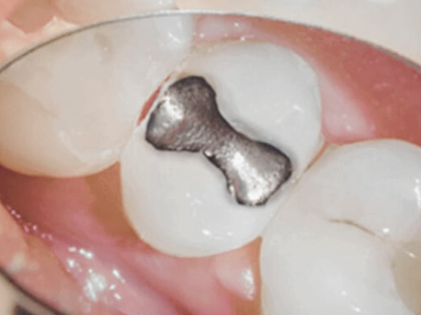 마곡치과_1. 아말감 충전, 아직 있어도 괜찮을까요? 수은 걱정에 대한 현실 답변 관련 이미지 5