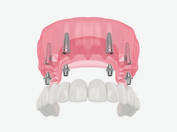 Magok Dental Clinic_ 5. A Complete Guide to Full-Mouth Implant Prices: How Much Will I Actually Pay? image 1