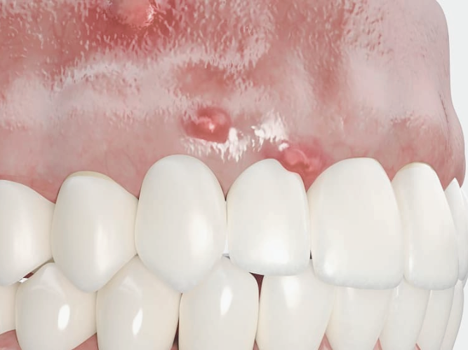 마곡치과_2. 재신경치료 필요한 상황 4가지, 신경치료 했는데 다시 아프다면? 관련 이미지 3