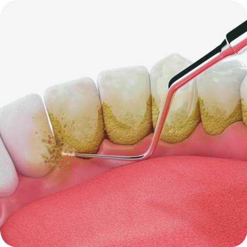 마곡역치과_ 7. 치주질환 예방, 어렵지 않습니다! 실천 가능한 6가지 꿀팁 관련 이미지 2