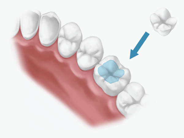 마곡동치과_1. 인레이 보철 치료, 언제 필요한가요?[ 치료 시기와 증상 정리 ] 관련 이미지 3