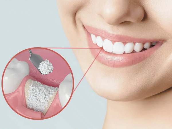 마곡동치과_2. 임플란트 뼈이식에 사용되는 재료의 모든 것 관련 이미지 5