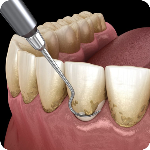 마곡동 치과_5. 치주질환 치료, 어디까지 해봤니? 단계별 잇몸 관리 총정리 관련 이미지 2