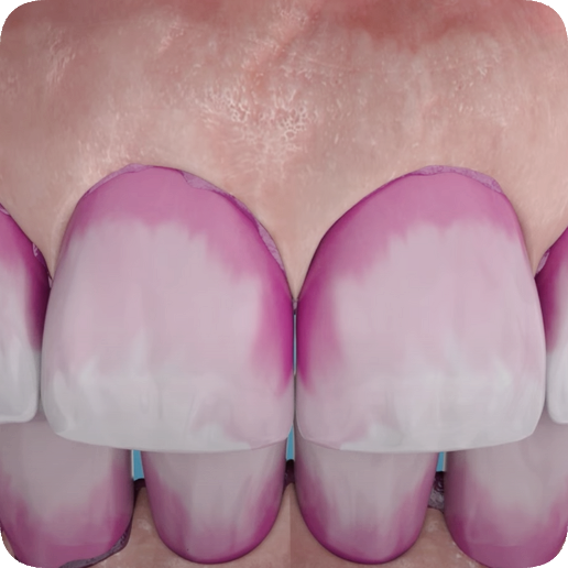 마곡역치과_&ldquo;치아가 개운해지는 6단계 여정&rdquo; [ 4.  에어플로우 스케일링 과정 ] 관련 이미지 3