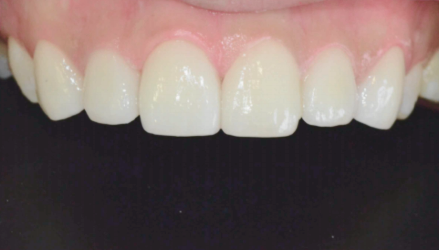 마곡역치과_3. 무삭제 라미네이트(디아네이트) 시술 과정 관련 이미지 2