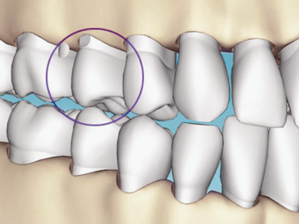 마곡역치과_5. 크라운 보철물 손상과 탈락, 원인과 치료 관련 이미지 3