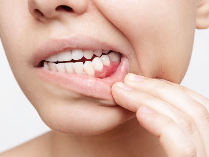 마곡치과_잇몸에 연어주사? PDRN 시술로 되살리는 건강한 잇몸 재생 솔루션 관련 이미지 4