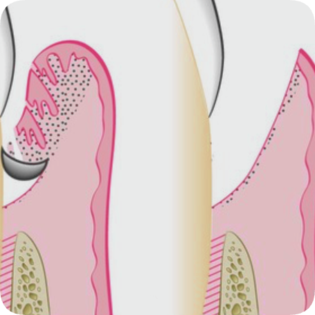 마곡동 치과_5. 치주질환 치료, 어디까지 해봤니? 단계별 잇몸 관리 총정리 관련 이미지 4