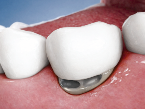 마곡역치과_6. 치수염, 예방할 수 있을까요? 초기 관리 방법 관련 이미지 3