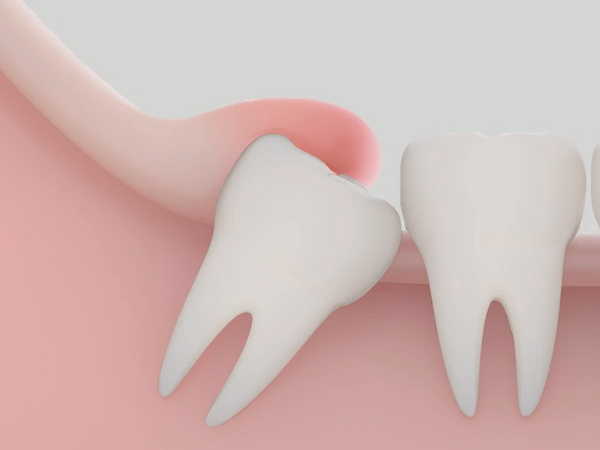 마곡역치과_4. 성인 초기(20~30대) 치아 문제 늘어나는 이유와 구강관리 핵심 관련 이미지 4