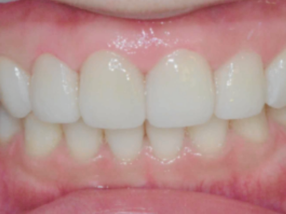 마곡역치과_3. 레진변색, 디아네이트 무삭제 라미네이트 케이스 관련 이미지 6