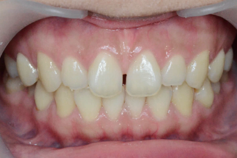 마곡동치과_4. 무삭제 라미네이트(디아네이트) 리얼 후기 3가지 케이스 관련 이미지 1