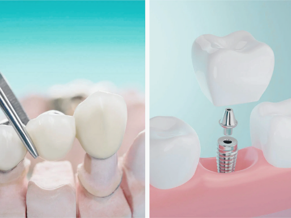 마곡역치과_&ldquo;금의 깊이가 다르면 치료도 달라집니다!&rdquo;[3. 치아 금(균열) 치료] 관련 이미지 10