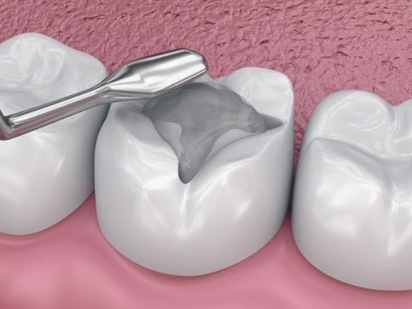 마곡치과_1. 아말감 충전, 아직 있어도 괜찮을까요? 수은 걱정에 대한 현실 답변 관련 이미지 2