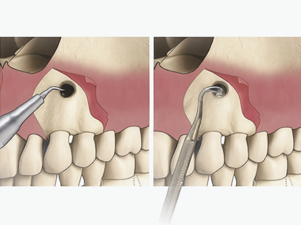 마곡동치과_&ldquo;이빨 뿌리 끝 염증, 이렇게 해결합니다!&rdquo; [2. 치근단절제술 과정] 관련 이미지 5
