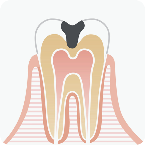 마곡동치과_1. 인레이 보철 치료, 언제 필요한가요?[ 치료 시기와 증상 정리 ] 관련 이미지 5