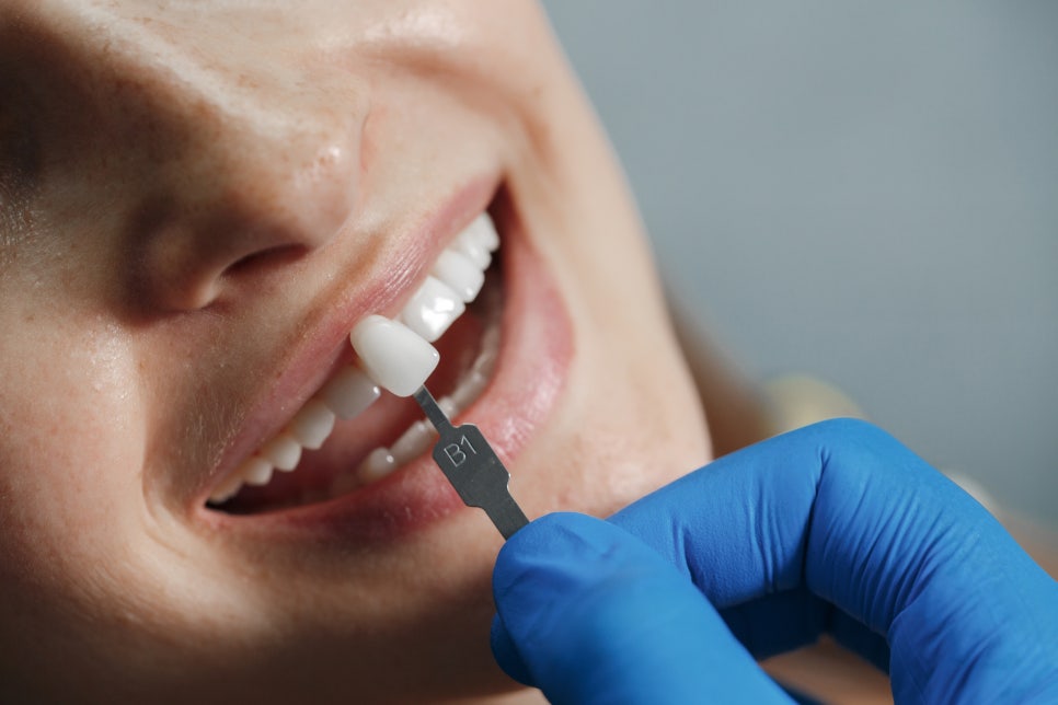 [ Magok Veneers_02 ] How Are Veneers Different from Crowns and Teeth Whitening? image 3