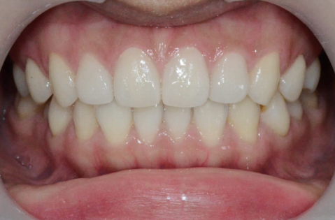 마곡동치과_4. 무삭제 라미네이트(디아네이트) 리얼 후기 3가지 케이스 관련 이미지 2