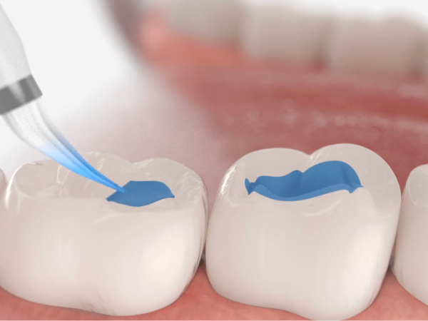 Magaok Station Dental Clinic_ &ldquo;It doesn’t hurt and it’s over quickly&rdquo; [3. Dental Sealant Procedure Process] image 3