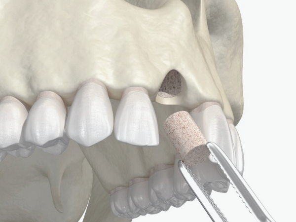 [ 마곡동치과_치아 상실 2 ] 치아 빠졌을 때 치료, 지금 해야 할까요? 미루면 더 복잡해집니다 관련 이미지 2