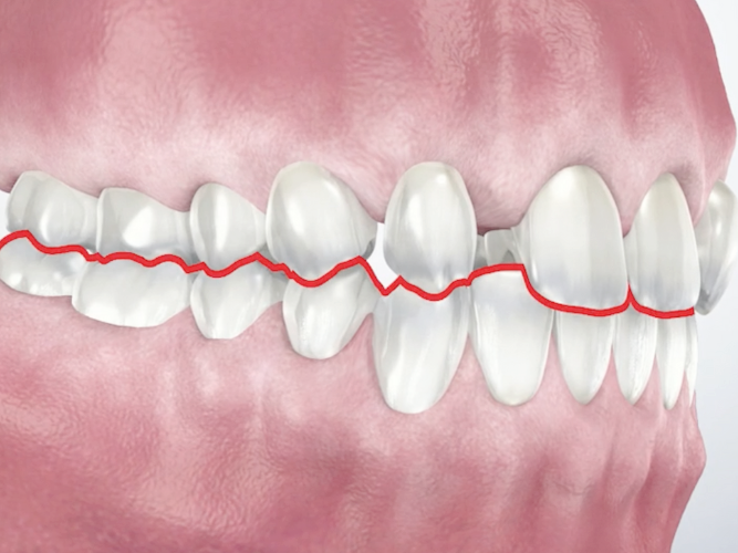 Magaok Station Dental Clinic_ “Why Do Gums Recede?” [1. Causes of Gingival Recession] image 5