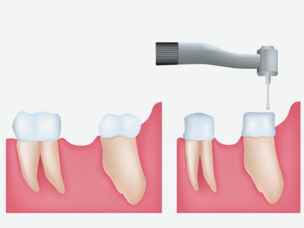 마곡동치과_3. 브릿지 치료는 어떻게 진행될까요? 실제 과정 순서대로 정리 관련 이미지 2