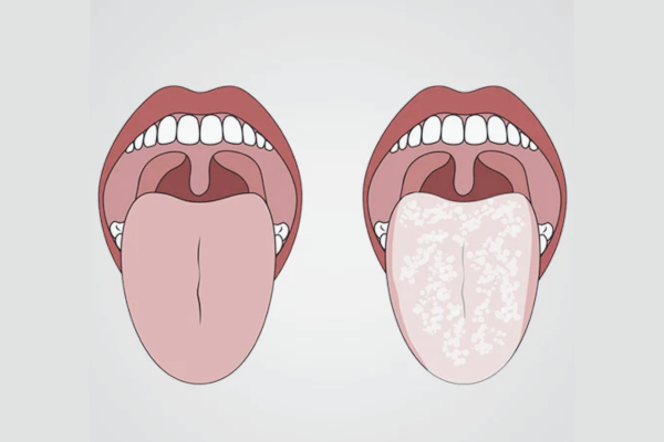 마곡역치과_7. 노년기(70대 이상) 구강관리, 오래 쓰는 치아를 편안하게 지키는 방법 관련 이미지 2