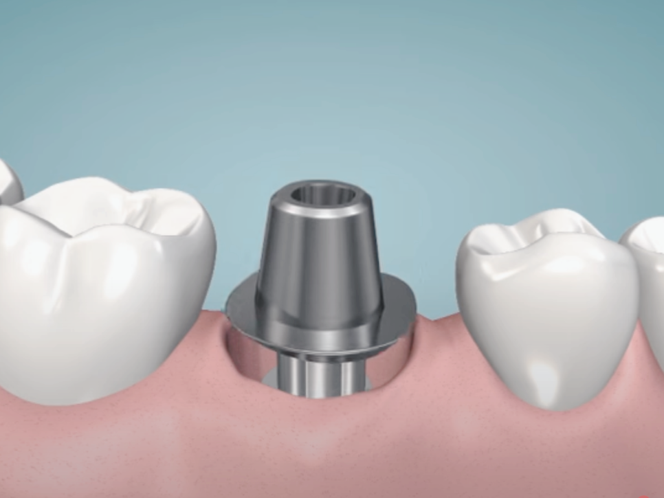 마곡역치과_"씹는 즐거움, 웃는 자신감, 내 이 같은 자연스러움" [ 3. 임플란트 수술과정 ] 관련 이미지 5