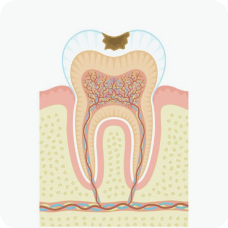 마곡동치과_"방치하면 임플란트까지?" [ 3. 충치 진행 단계별 치료 ] 관련 이미지 2