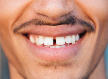 [ Magok Veneers_03 ] When Are Veneers Suitable? A Summary of Indications image 3