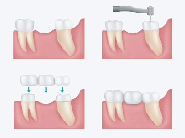 [ 마곡동치과_치아 상실 4 ] 브릿지 치료, 빠르게 해결 가능하지만 괜찮을까요? 관련 이미지 2