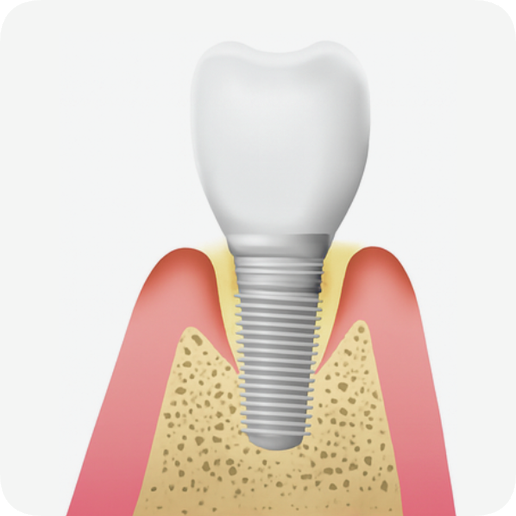 마곡동치과_"조용히 시작해 결국 흔들리는 이유" [ 3. 임플란트 주위염 진행 과정 ] 관련 이미지 3