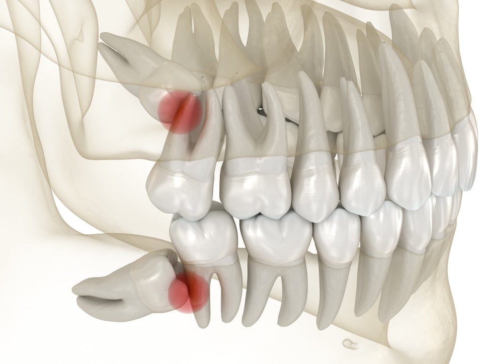 마곡동치과_1. 사랑니염증 원인, 왜 유독 사랑니만 문제를 만들까요? 관련 이미지 2