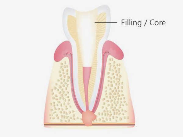 마곡역치과_ "크라운 씌우기 전, 코어와 포스트 꼭 해야 하나요?" [6. 신경치료 후 보강치료 필요성 ] 관련 이미지 2