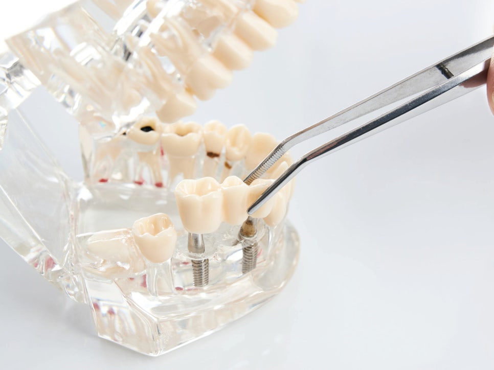 마곡역치과_"내 치아를 지키는 가장 스마트한 선택" [ 4. 임플란트 장점과 단점 ] 관련 이미지 1