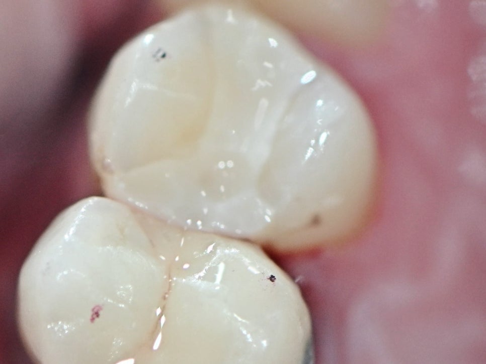 마곡동치과_당일 인레이 치료 과정 관련 이미지 9