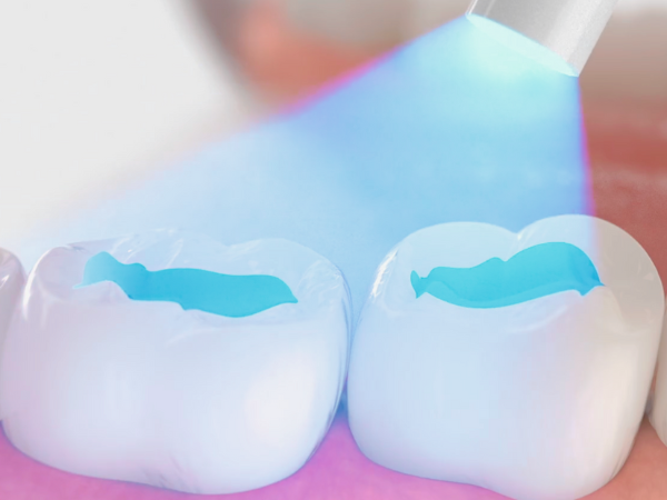 Magaok Station Dental Clinic_ &ldquo;It doesn’t hurt and it’s over quickly&rdquo; [3. Dental Sealant Procedure Process] image 4