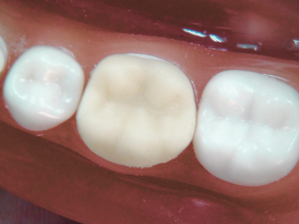 마곡치과_5. 재신경치료 후 주의사항, 치료 후 관리가 더 중요합니다 관련 이미지 3